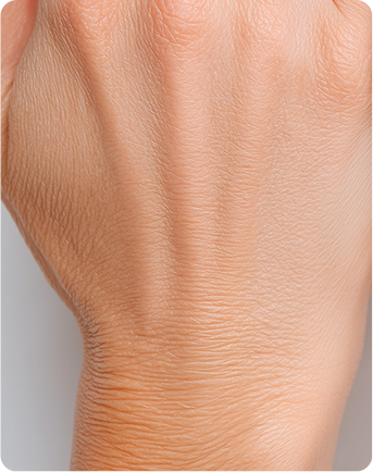 Woman Hand - After Treatment