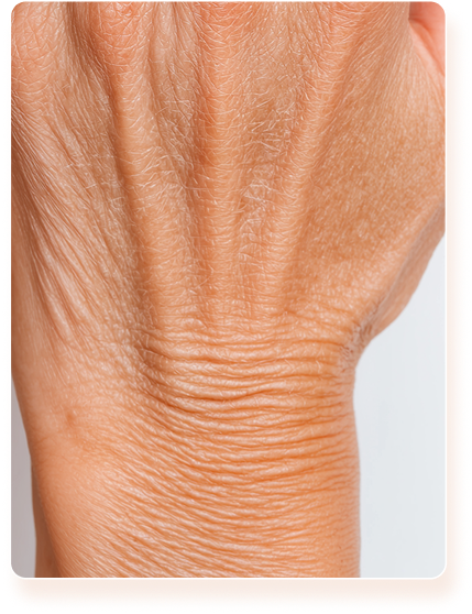 Woman Hand - Before Treatment