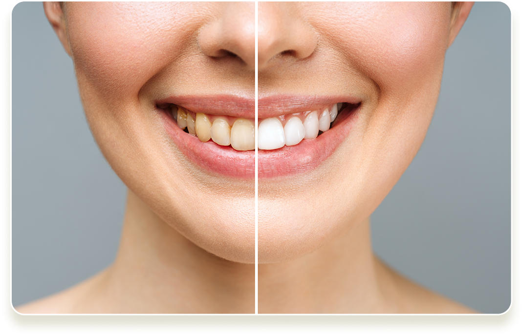 Woman Teeth - Before and After
