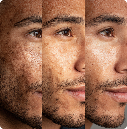 Man Face - Before and After using Lifecell Peel