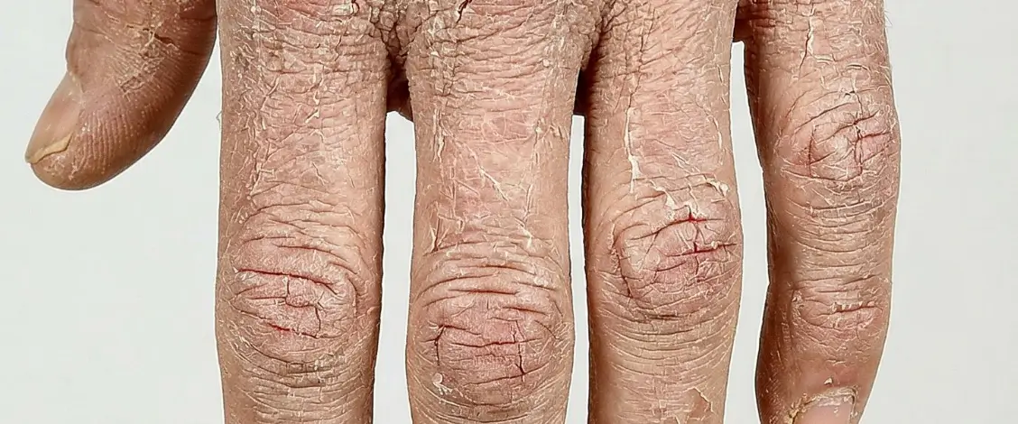 Cracked Hand