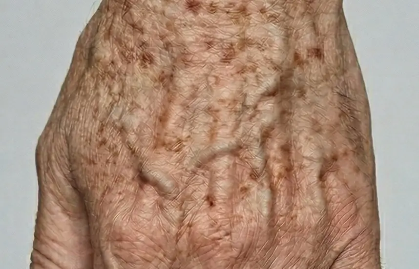 Hand with Dark Spots