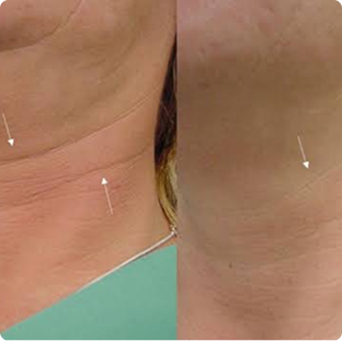 Woman Neck - Before and After