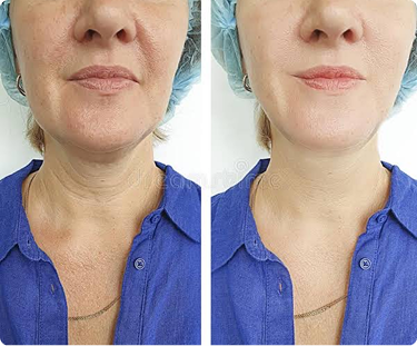 Woman Neck - Before and After