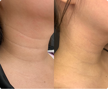 Woman Neck - Before and After
