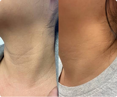 Woman Neck - Before and After
