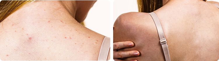 Woman Skin - Before and After