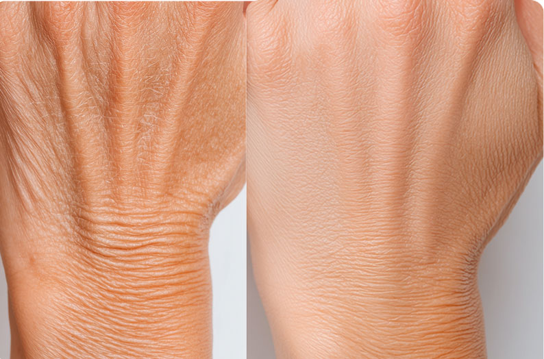 Woman Hand - After Treatment